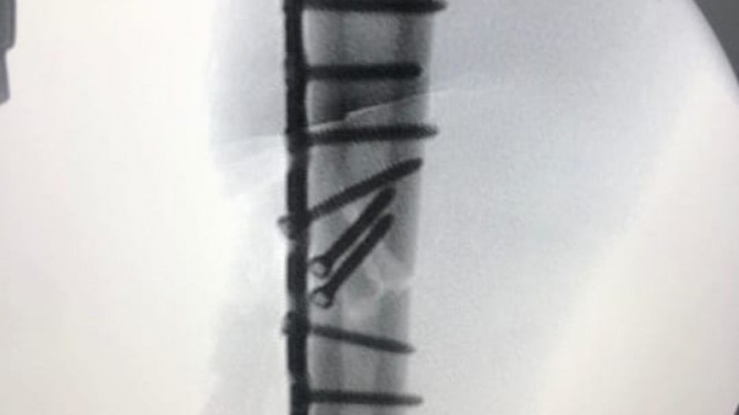 Penampakan Tulang Lengan Marquez Patah