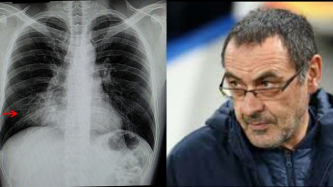 Ini Cara Mencegah Pneumonia Atau Paru Paru Basah yang Menyerang Maurizio Sarri