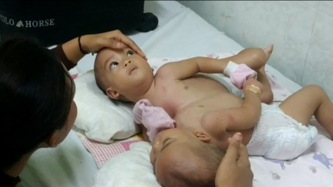 Tim Dokter: Bayi Kembar Siam Naya dan Anaya Dapat Dipisahkan