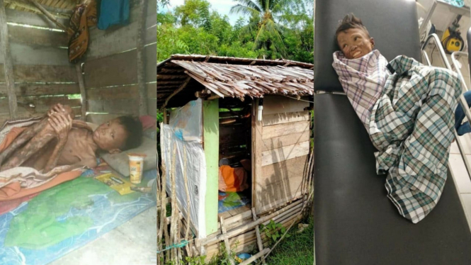 Memilukan, Dua Anak Yatim Tingga di Gubuk dan Dijauhi Karena Miliki Penyakit Aneh (Foto Kolase Facebook)