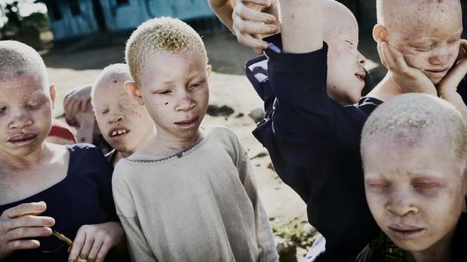 Teror Sadis! Orang Albino Afrika Diburu dan Dibunuh Demi Kekuatan Magis