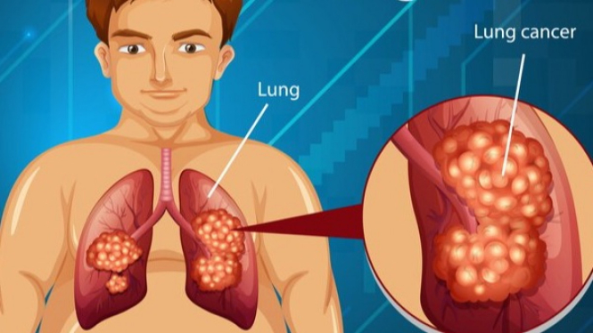 Ilustrasi kanker paru-paru