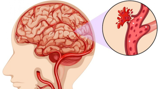 Ilustrasi Pendarahan Otak