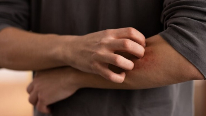 Ilustrasi serangan gatal pada kulit