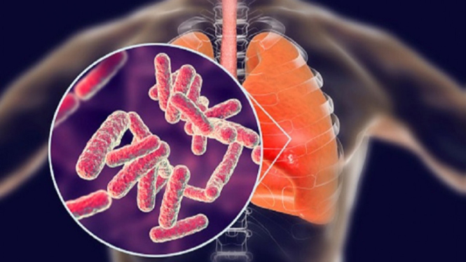 Menyoroti 6 Fakta Menarik Tentang Tuberkulosis (TBC) di Indonesia