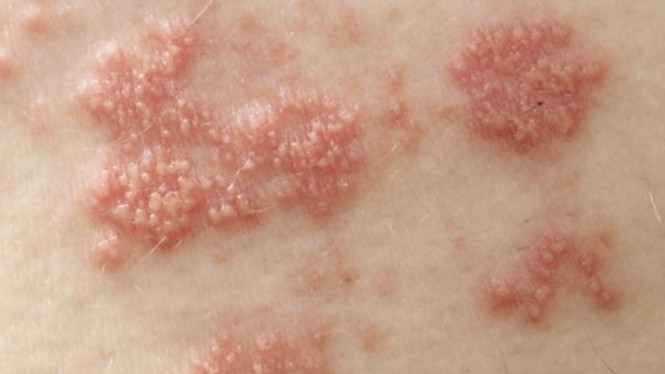 propolis obati herpes