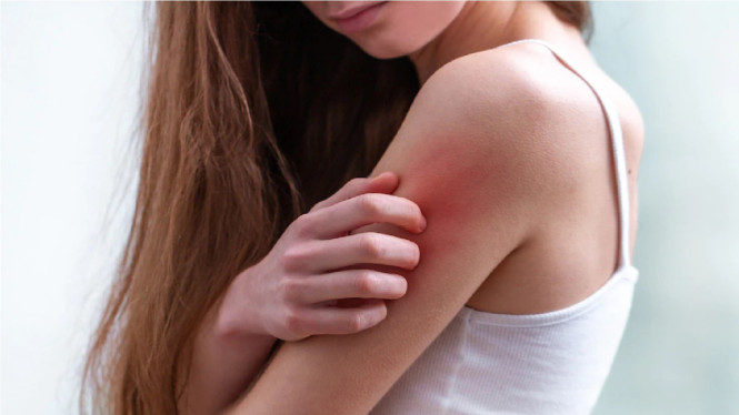 Jangan Garuk Kulit yang Gatal