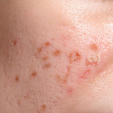 Memperbaiki Skin Barrier