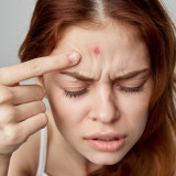 Jerawat Muncul di Jidat