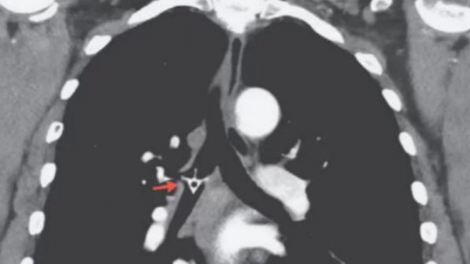 Tulang ayam di dalam paru-paru.