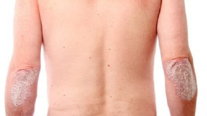 Psoriasis dan asam urat.