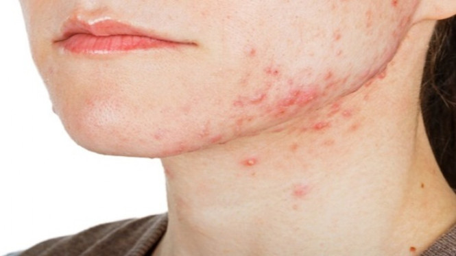 Ilustrasi jerawat yang semakin meradang.