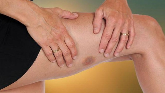 Ilustrasi tanda kanker kulit