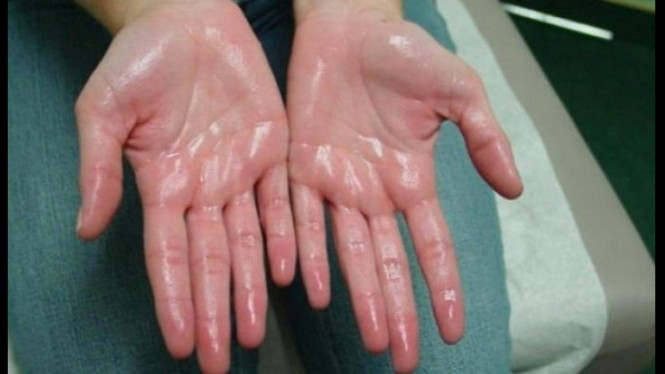 Telapak tangan berkeringat