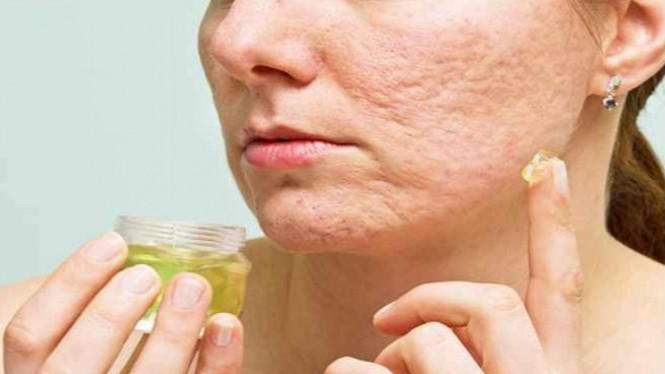 Krim alami penghilang bopeng bekas jerawat