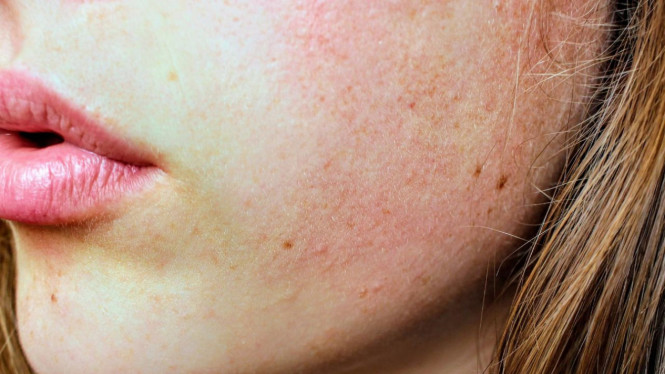 Ilustrasi skin tag di wajah.