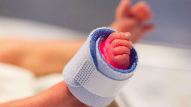 Ilustrasi kelahiran prematur