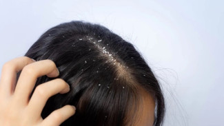 Rambut Rontok dan Ketombe Nggak Kunjung Hilang? Atasi Sekaligus dengan Tips Ini!