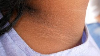 Leher Hitam Karena Diabetes? Ini 5 Cara Mengatasinya!