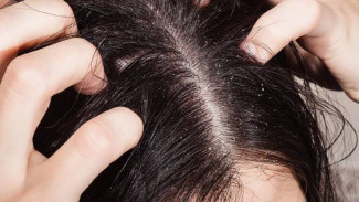 Gk Nyangka ! Hilangin Ketombe Cuma Pakai Bahan Dapur, Tanpa Harus Ke Salon