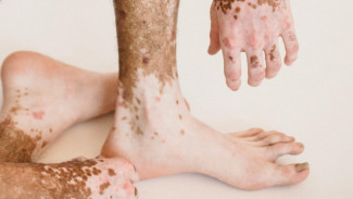 Tren Obat Kulit Tanpa Resep Ancam Kesehatan, Ini Kata Ahli Dermatologi