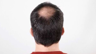 Rahasia Rambut Kembali Lebat, Panduan Lengkap Mengatasi Kebotakan