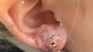 Awas! Salah Pilih Bahan Tindik, Telingamu Bisa Infeksi Parah!