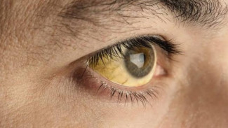 7 Golongan Orang Ini Wajib Tes Hepatitis, Meski Tak Bergejala