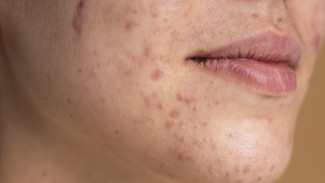 6 Kenali Penyebab Wajah Bruntusan Biar Gampang Diatasi