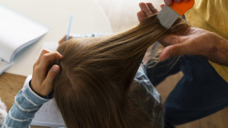 Anak Kutuan, Begini Cara Penularan dan Pengobatan Kutu Rambut