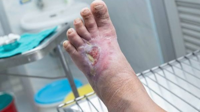 Salah satu tanda diabetes bisa dilihat dari kondisi kaki