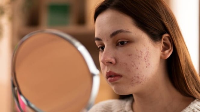 Wanita yang Mengalami Jerawat Hormonal pada Bagian Pipi