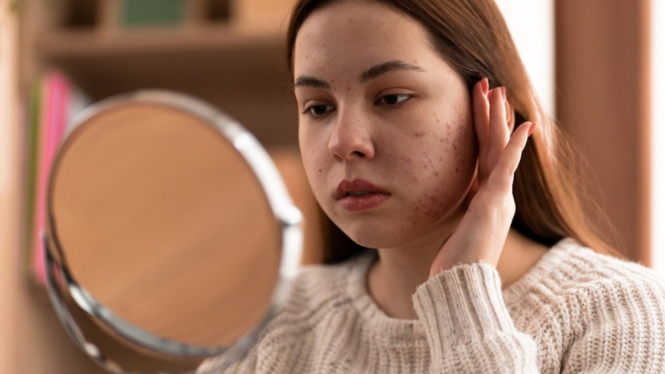 Perempuan dengan bruntusan di wajahnya