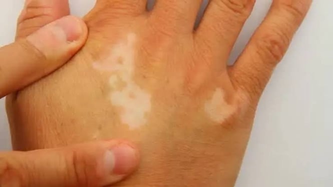 Vitiligo penyakit kulit yang sering dikira panu atau jamur