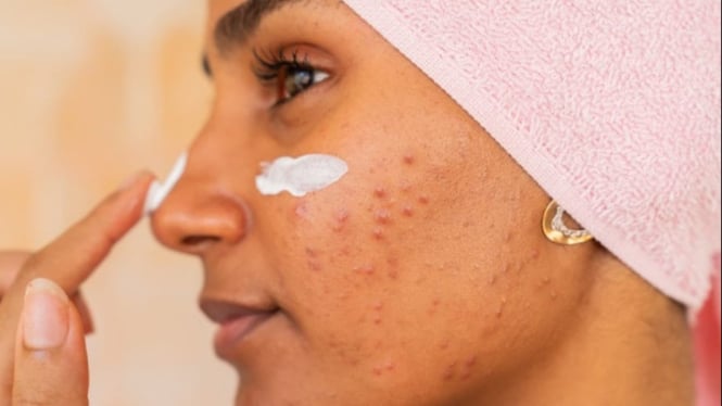 Seorang wanita dengan jerawat di wajah