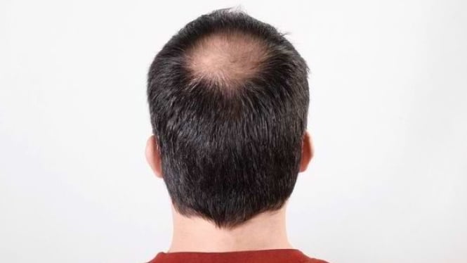 Seorang pria yang mengalami kebotakan rambut