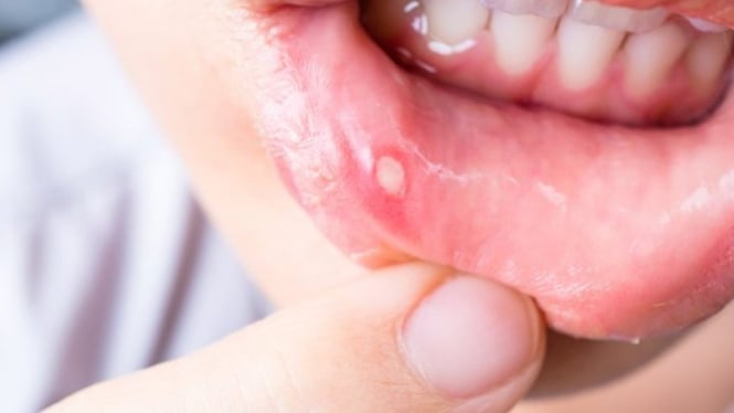 Bibir sariawan pada anak