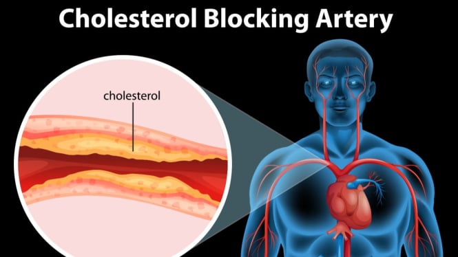 Ilustrasi kolesterol dalam tubuh.