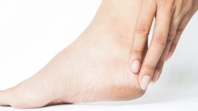 Jangan Sampai Alami Tumit Kaki Pecah-Pecah