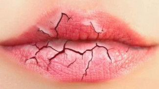 Penyebab dan Gejala Bibir Pecah-pecah, Berikut Cara Mengatasinya