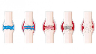 Cegah Patah Tulang dan Osteoporosis dengan Olahraga Simple Ini