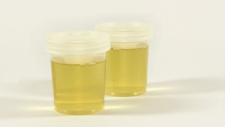Urine Berbusa, Waspada Gejala Ginjal Bocor