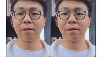 Beredar Video Wajah Asli dr Richard Lee, Terlihat Jelas Bekas Jerawat Seperti Bopeng