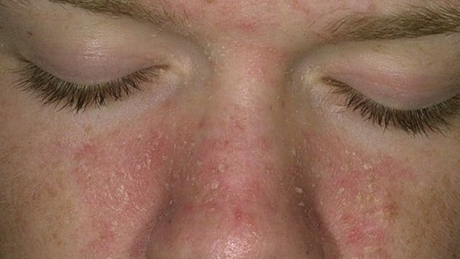 Ilustrasi dermatitis seboroik