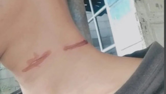 Senar Layangan Makan Korban, Pengendara Motor di Sragi Pekalongan Terluka