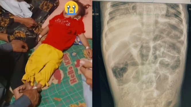 Balita meninggal dipenuhi cacing