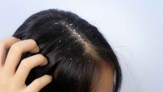 Penyebab Rambut Berketombe, Faktor Utama dan Solusi Mengatasinya