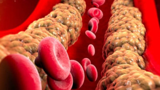 Turunkan Kolesterol Tanpa Obat, Ini Cara Mudah dan Efektif yang Harus Dicoba Agar Jantung Sehat!