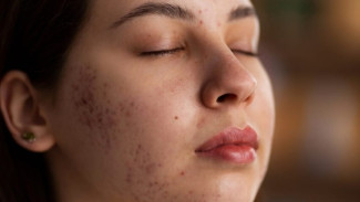 8 Cara Mengatasi Jerawat Tanpa Skincare, Tanpa Efek Samping!