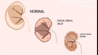 10 Cara Ampuh Merawat Ginjal Agar Tetap Sehat dan Berfungsi Optimal